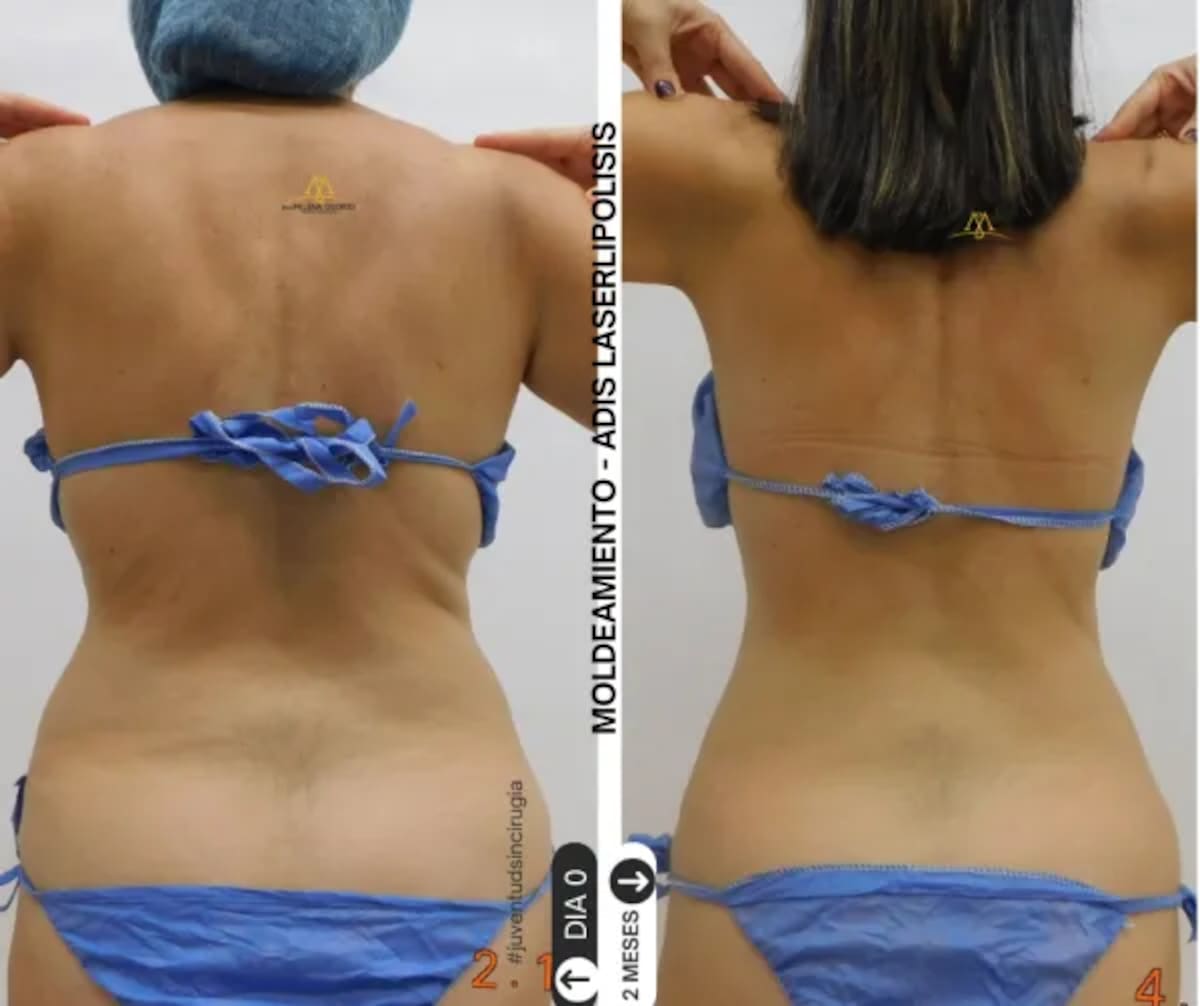 ADIS laserlipólisis es un tratamiento láser, no quirúrgico, mínimamente invasivo //
