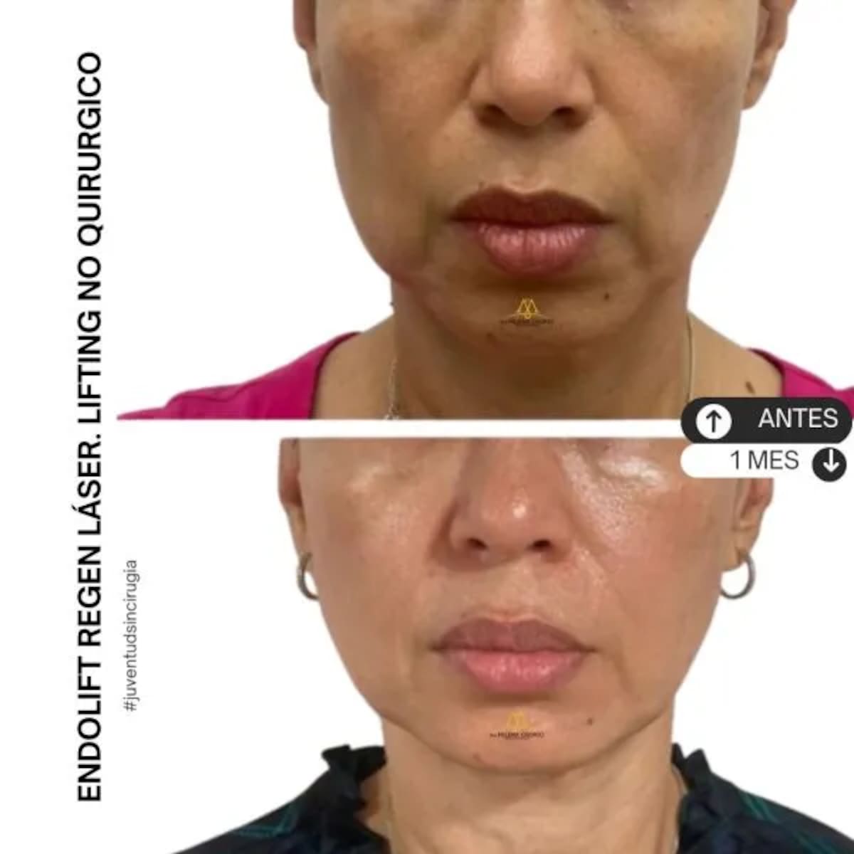 El endolift es un procedimiento médico estético no quirúrgico que utiliza tecnología láser para tensar y rejuvenecer la piel // CORTESÍA - SITIO WEB DOCTORA OSORIO.