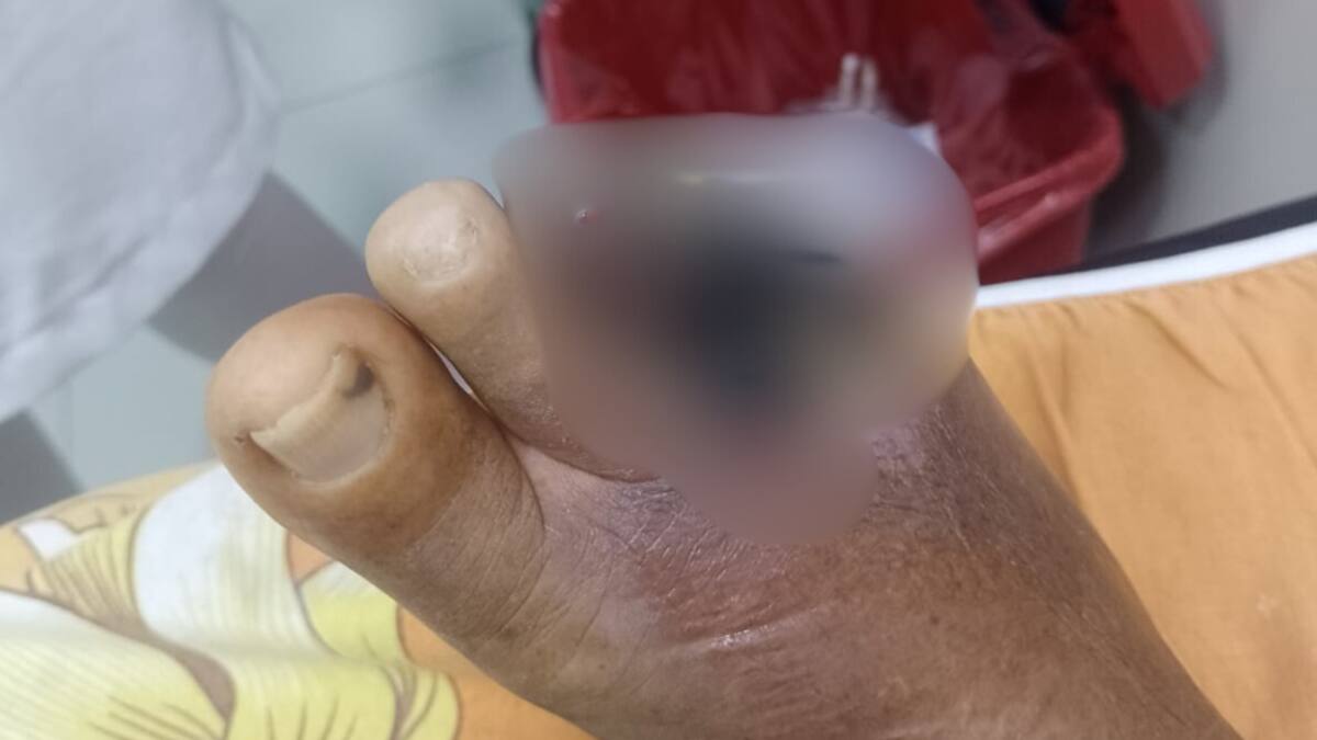 El pie de la señora Ana Julia Alcalá de Silva presenta un cuadro delicado. // Foto: cortesía - Familiares