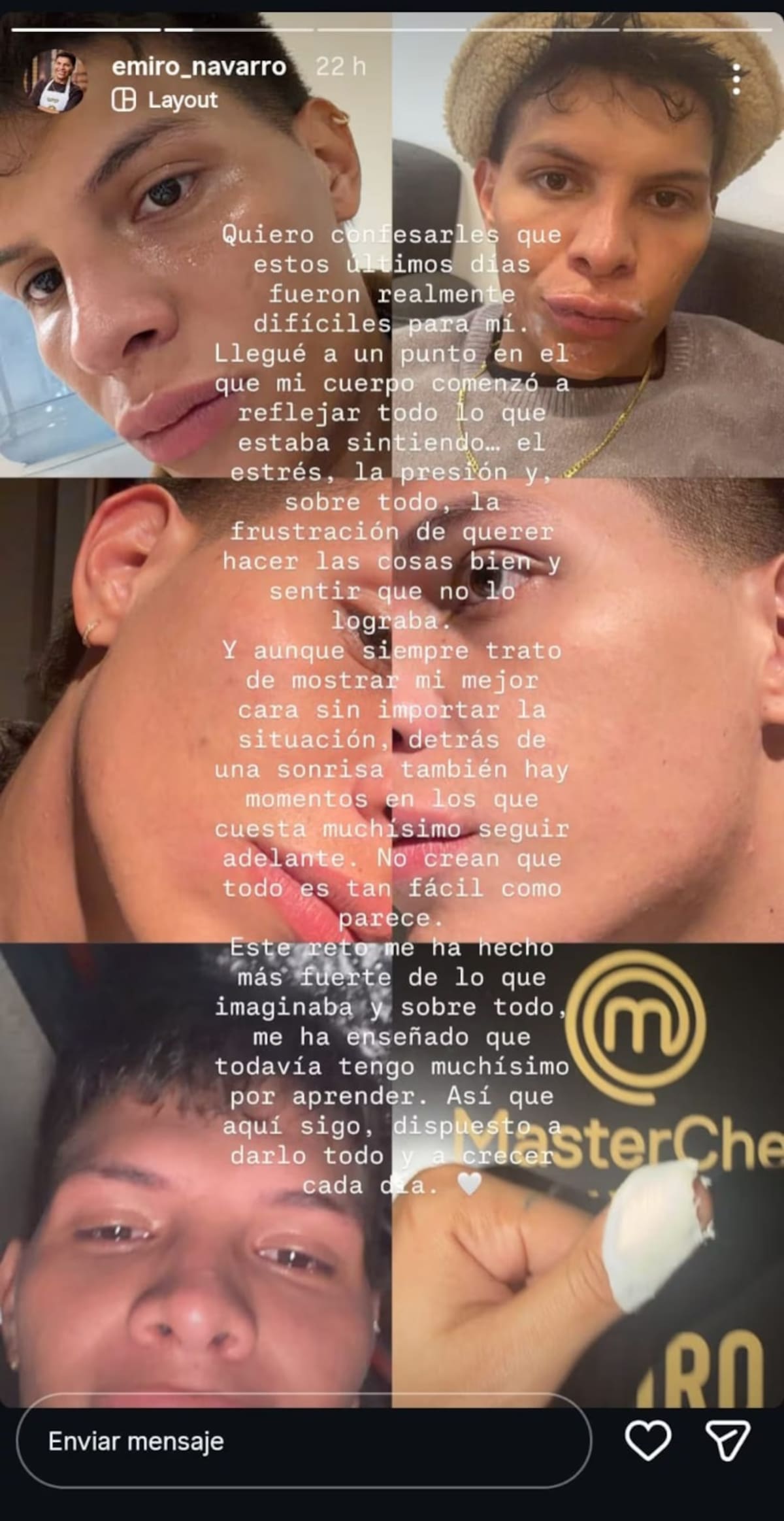 Emiro Navarro muestra las secuelas físicas que le dejó su paso por MasterChef Celebrity. //Foto: @emiro_navarro.