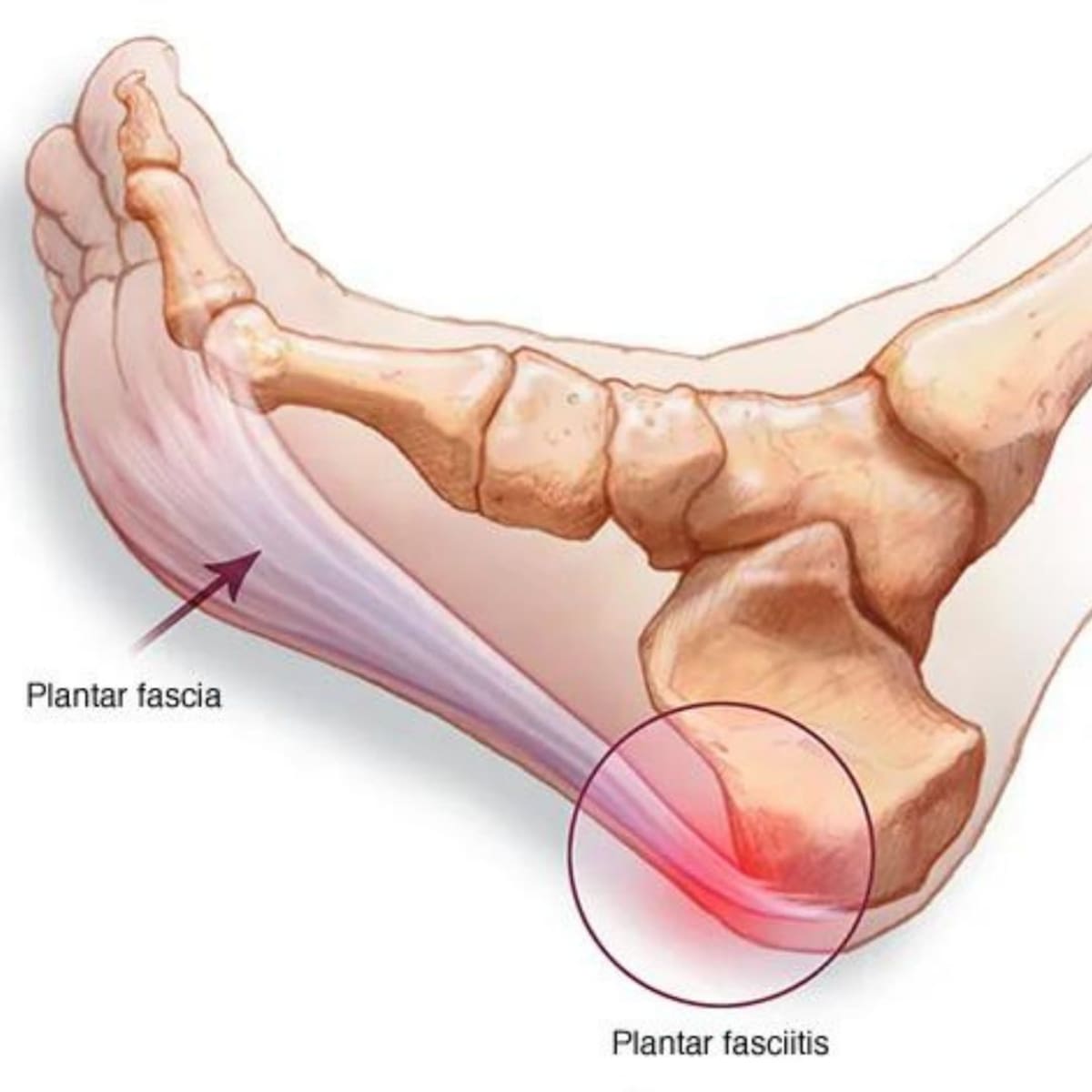 La fascitis plantar es una de las causas más comunes de dolor de talón. //Foto: Cortesía.