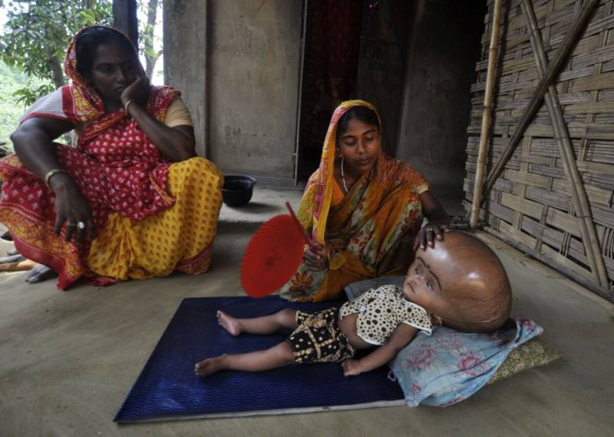 La niña Roona Begum, que sufre de hidrocefalia, junto a su madre. AFP ARINDAM DEY
