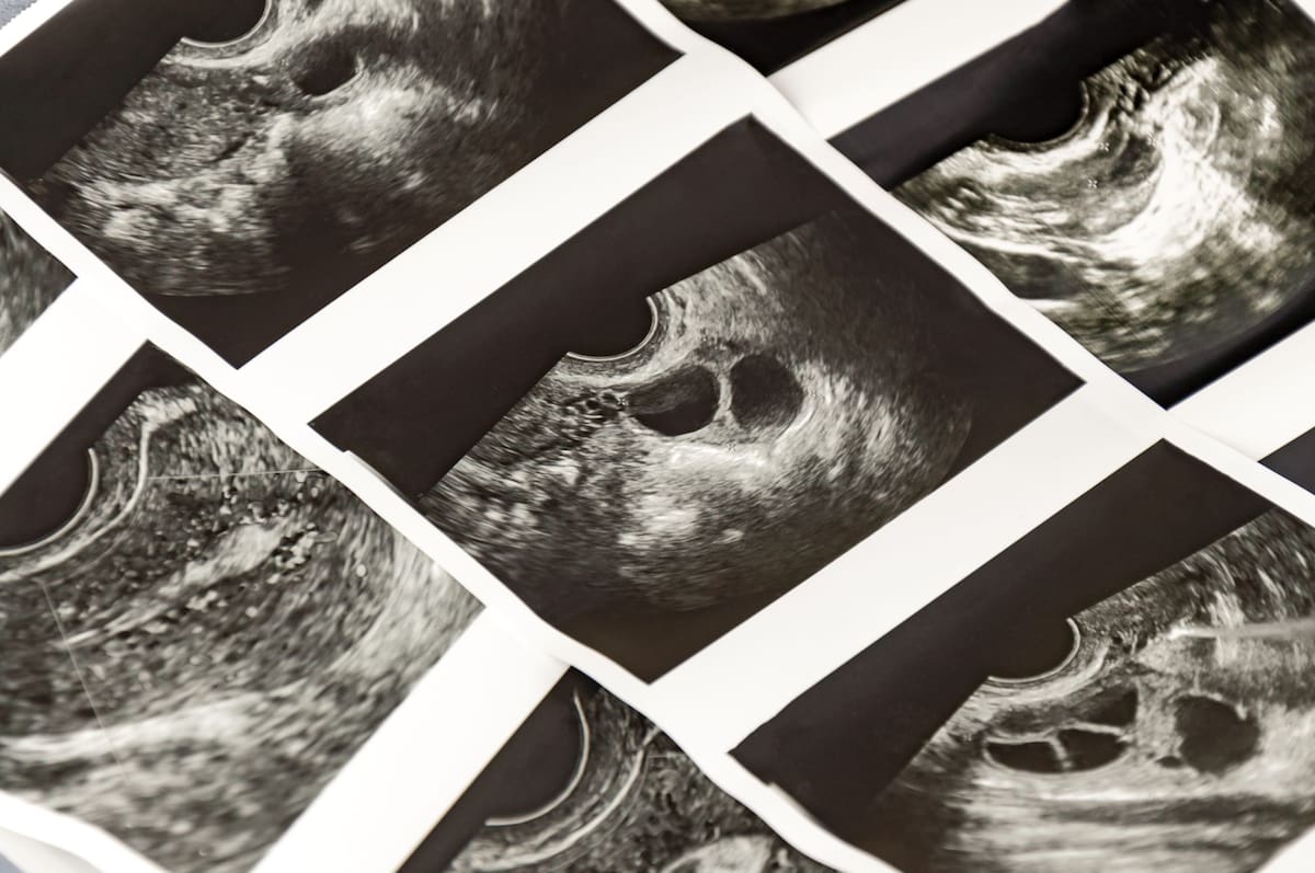 A medida que la edad de la mujer aumenta, especialmente después de los 40 años, hay una mayor probabilidad de alteraciones genéticas en el embrión que conducen a un aborto espontáneo.