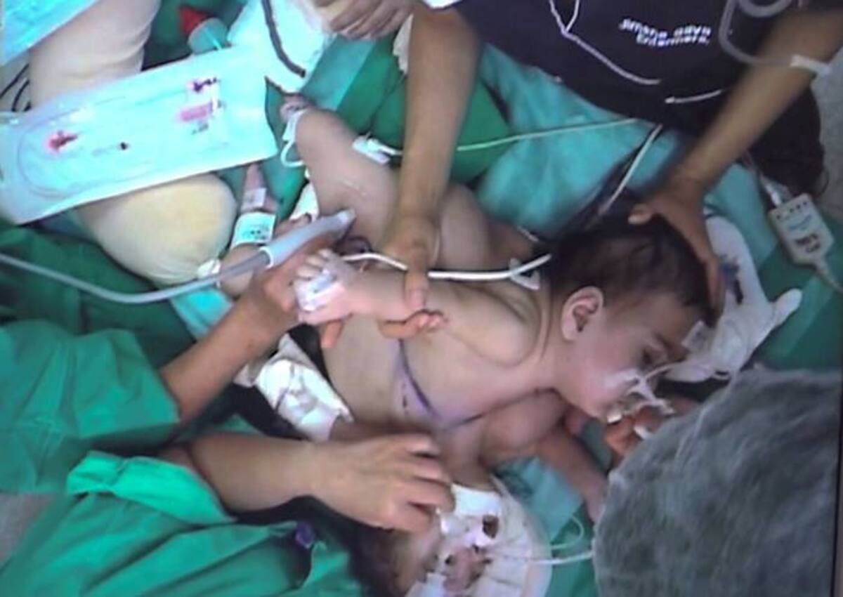 Un ejército de profesionales, que incluye 25 cirujanos y anestesistas, se han rotado para separar lentamente a las niñas nacidas hace 10 meses unidas por el tórax, el estómago, la pelvis y una pierna. AP