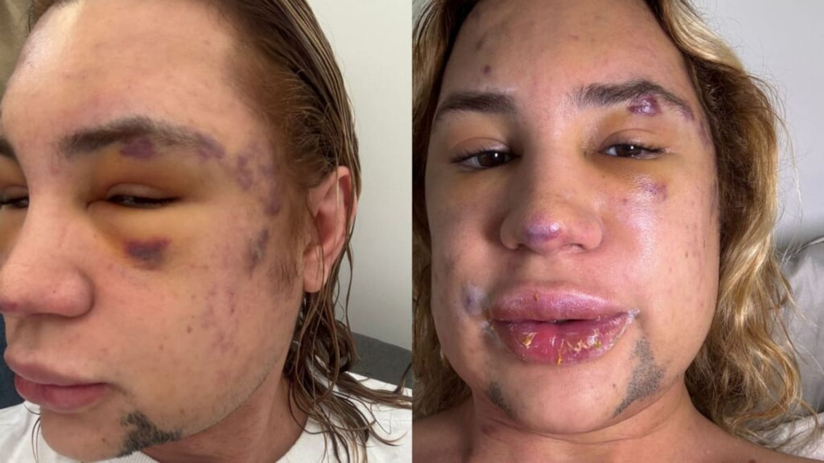 El influencer de moda Junior Dutra, de 31 años, murió tras sufrir complicaciones derivadas de un procedimiento estético que se había realizado. //Fotos: redes sociales.