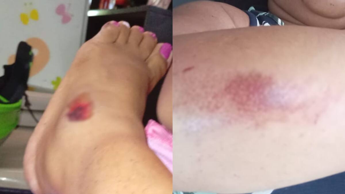 La mujer sufrió varias heridas cuando fue tumbada de su moto. // Foto: cortesía
