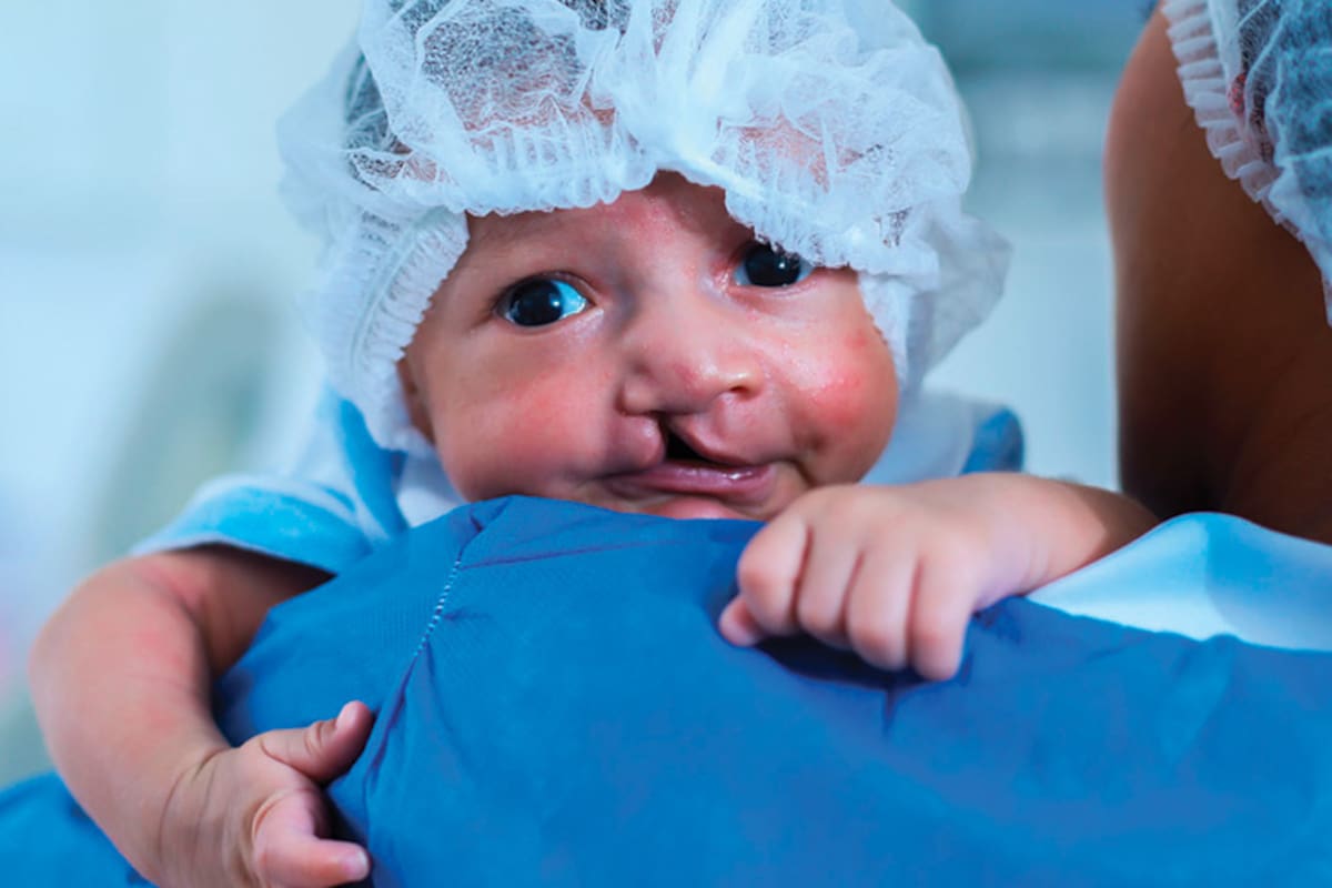 Cartagena tendrá jornada médica gratuita para niños con labio leporino