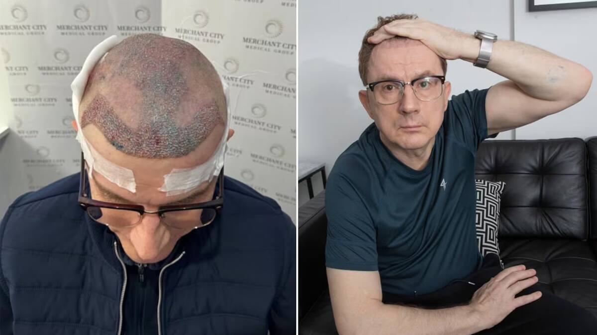 Mark Sweeney renunció a su trabajo tras transplante de cabello fallido. // Foto: Media Scotland/The Sun