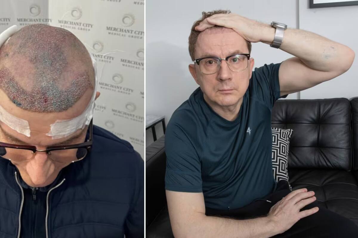 Trasplante de pelo fallido lo llevó a renunciar a su empleo: así pasó