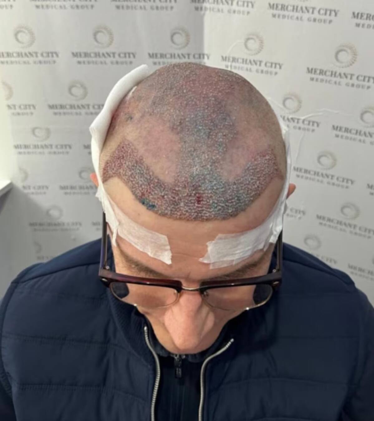 Así quedó su cabeza tras el procedimiento. // Foto: Media Scotland/The Sun
