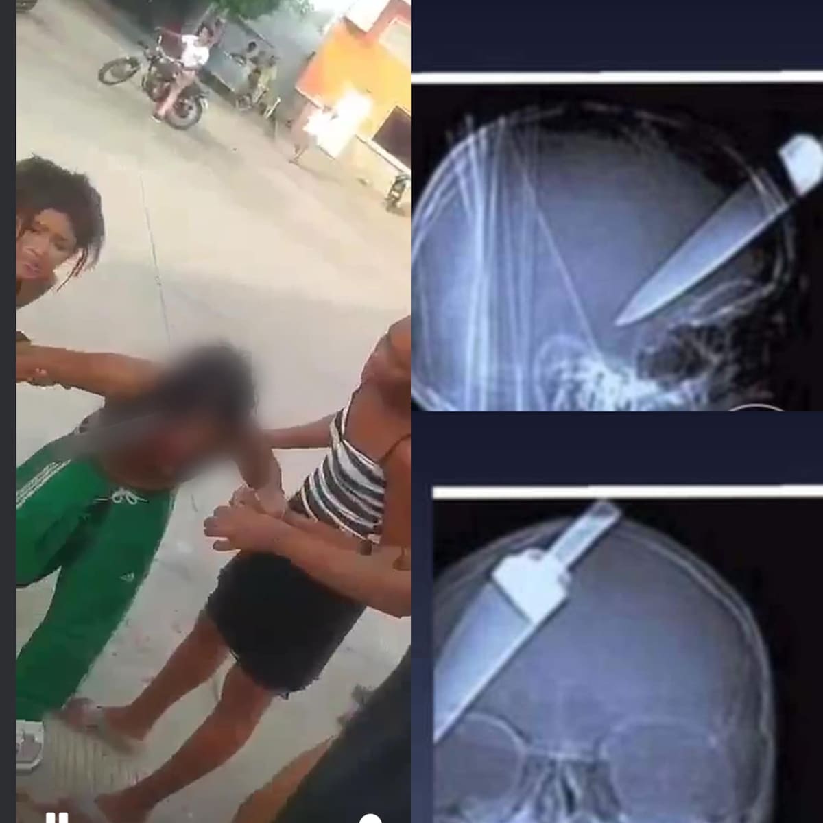 El reporte médico indica que la brutal cuchillada habría afectado parte del cerebro de la víctima.