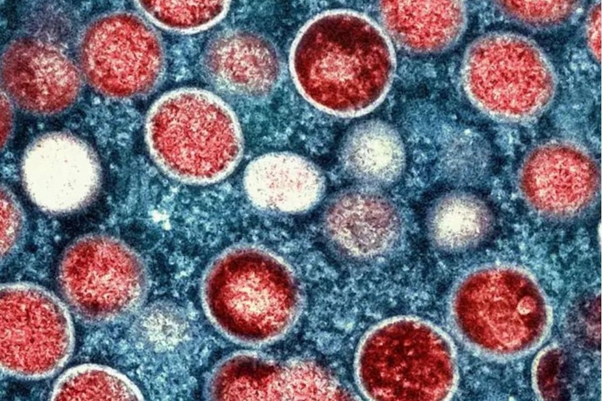 Viruela del mono: ¿América Latina está preparada para el Mpox?