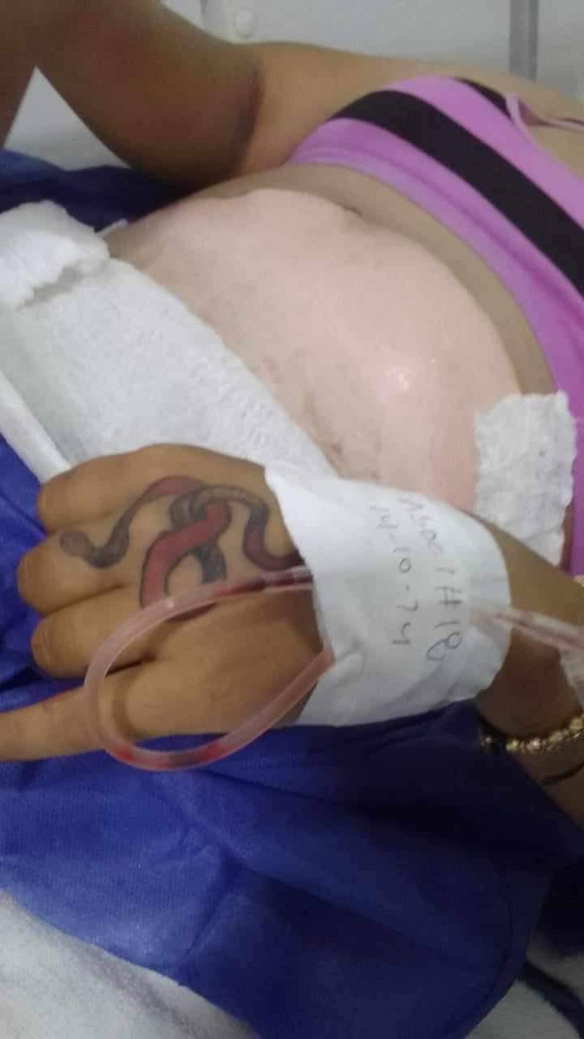 Mujer quemada por su exmarido