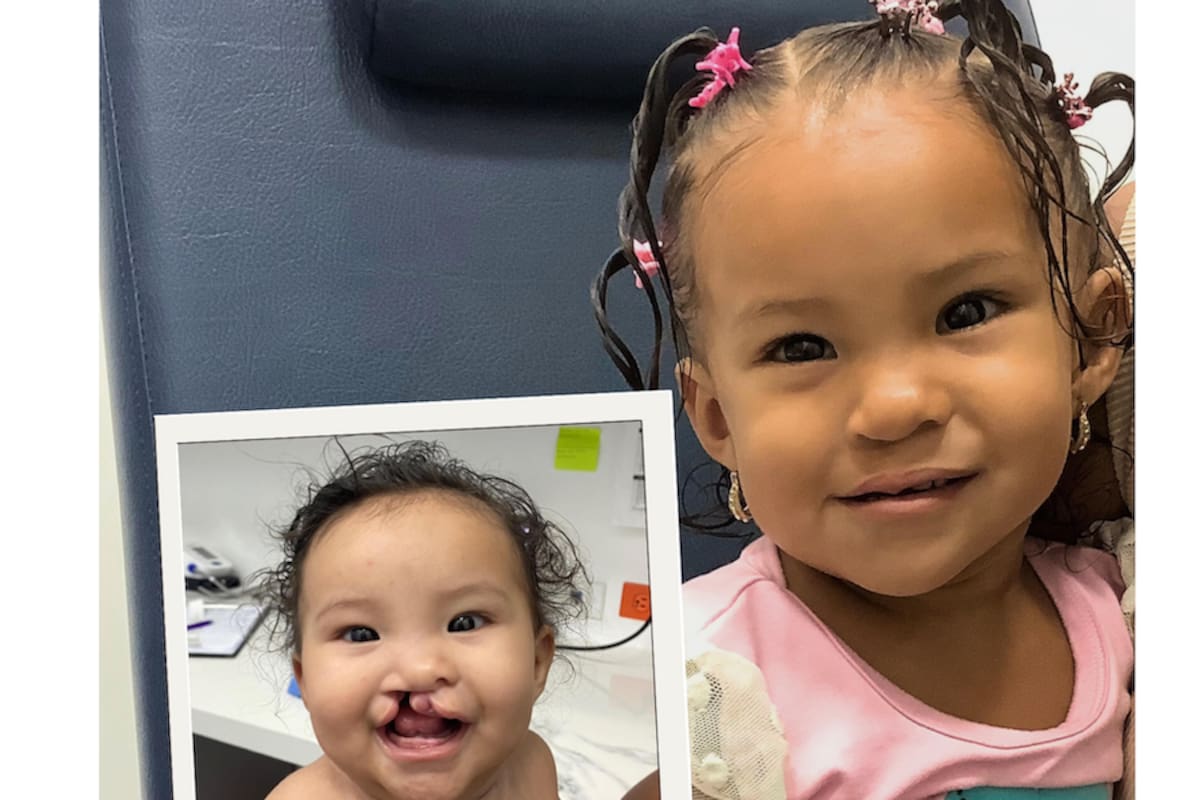 ¡Qué buena noticia! Cirugías gratuitas para niños con labio y paladar hendido