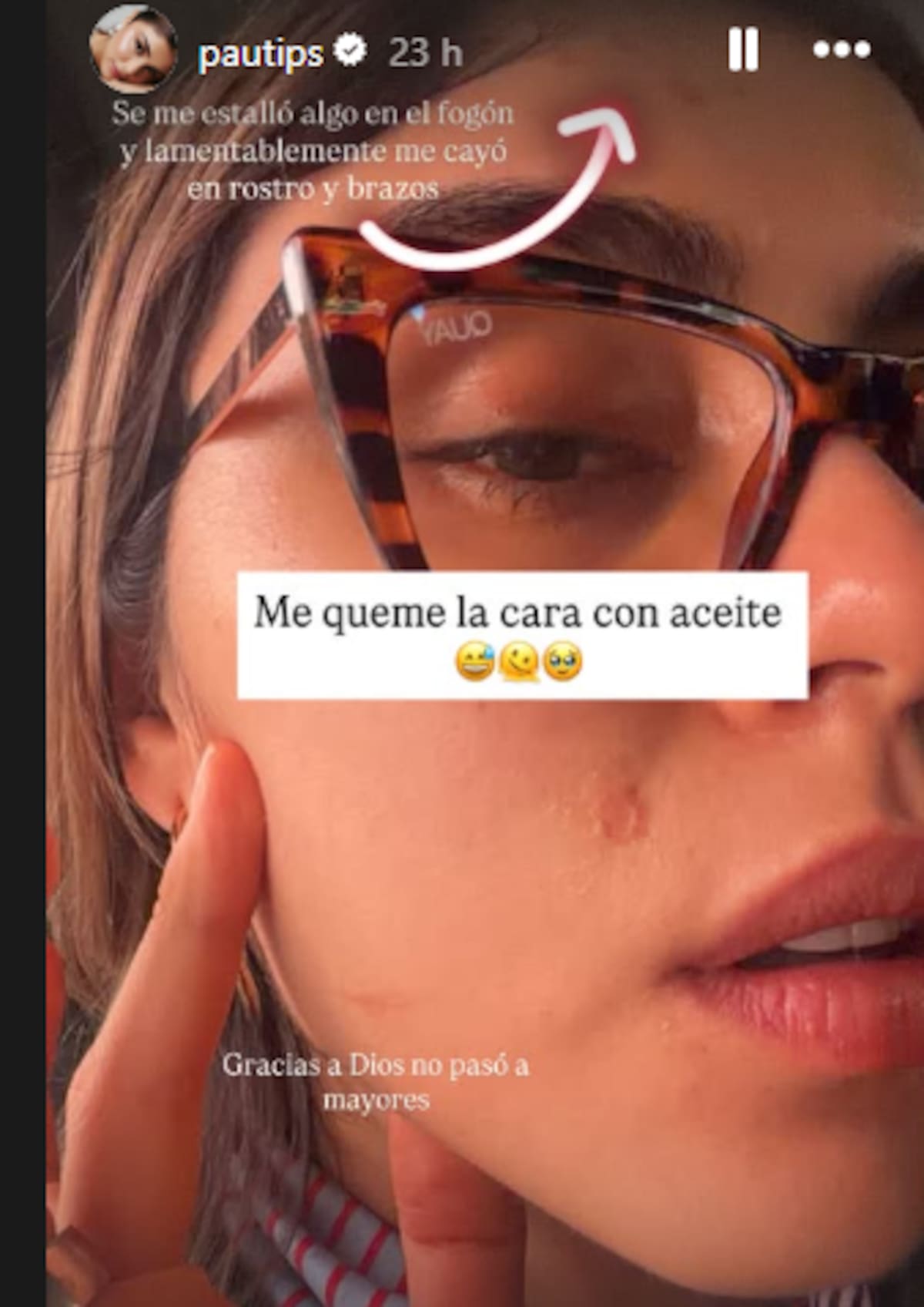 Pautips muestra como se quemó en MasterChef. //Foto: IG @pautips.