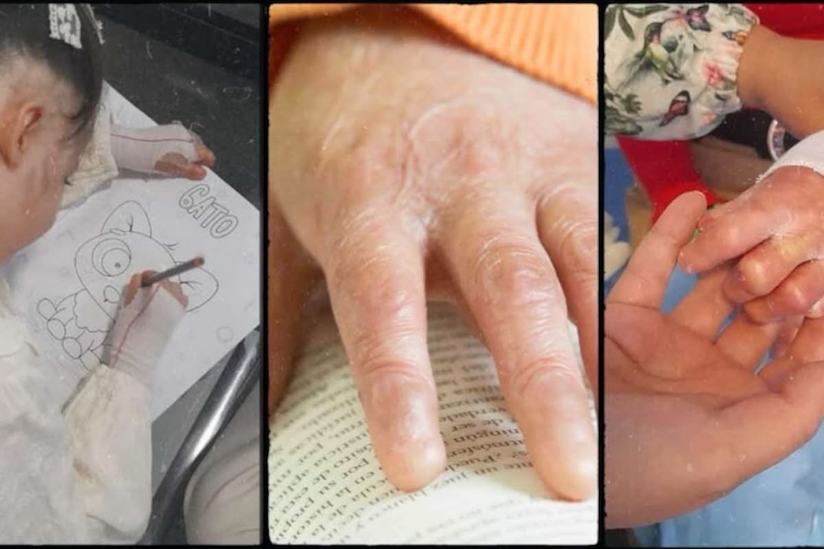En Barranquilla se reúnen 17 pacientes con piel de mariposa o Epidermólisis Bullosa