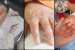 En Barranquilla se reúnen 17 pacientes con piel de mariposa o Epidermólisis Bullosa