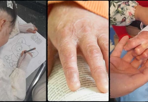 En Barranquilla se reúnen 17 pacientes con piel de mariposa o Epidermólisis Bullosa
