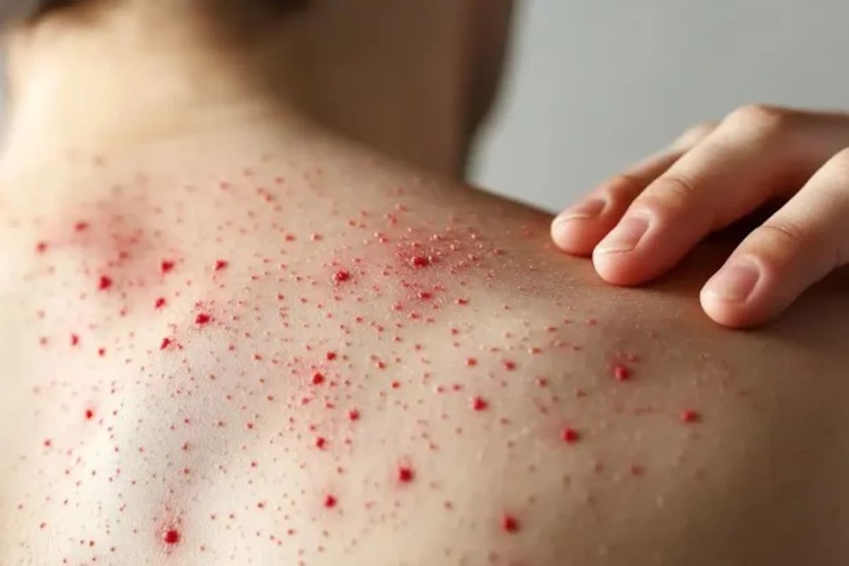 Alerta en Colombia por posible caso de sarampión tras más de 10 años sin contagios