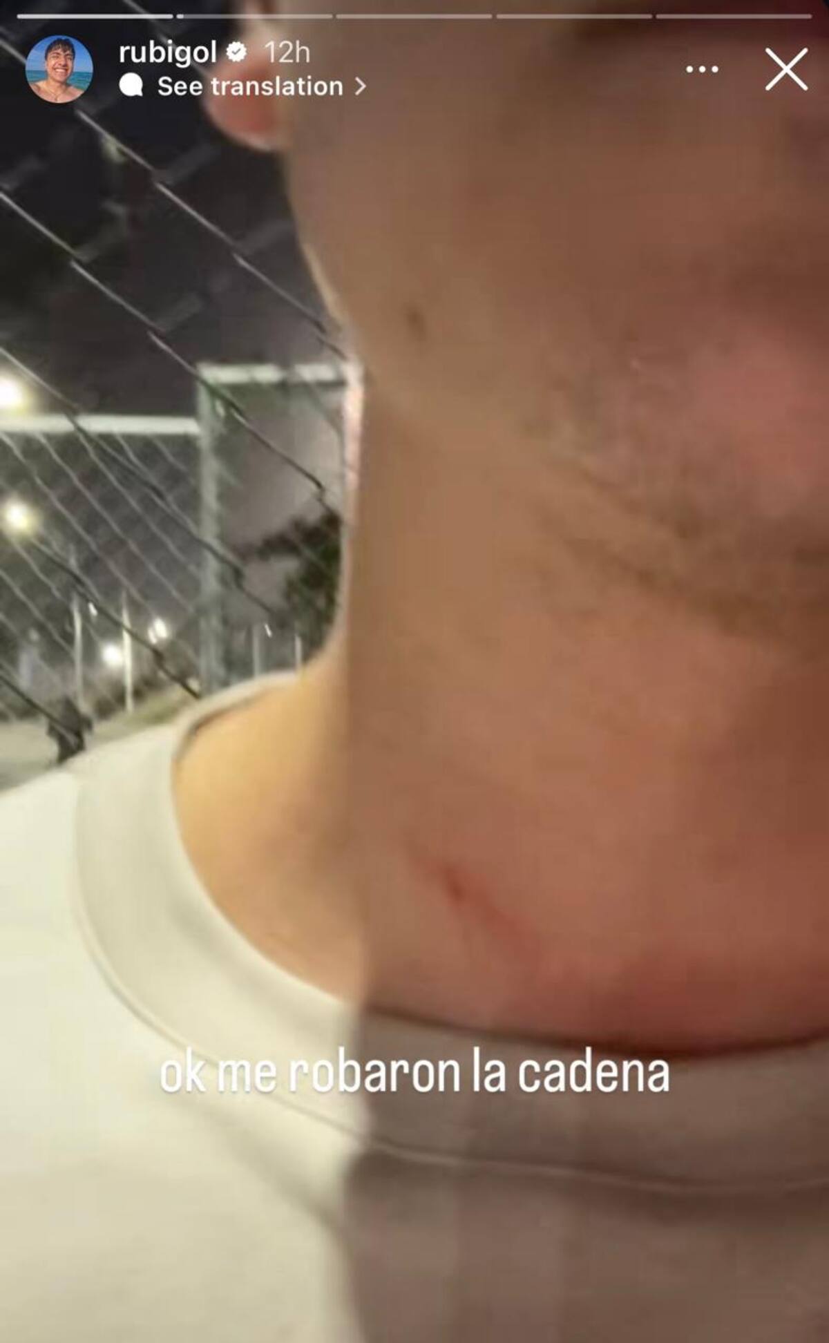 Rubigol mostró las heridas que le dejaron tras el hurto de su cadena de oro. //Foto: tomada de redes sociales.