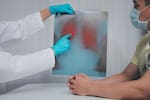 ¿Cómo se contagia la tuberculosis? Conozca sus síntomas, causas y tratamiento