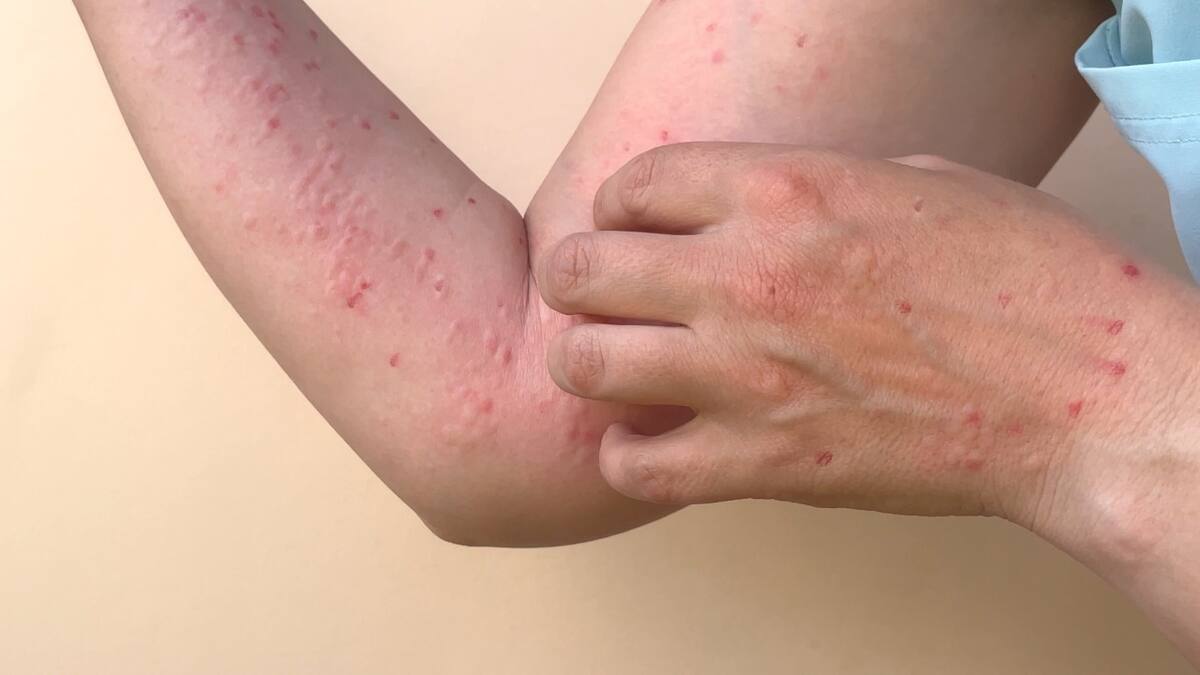 El mpox “sigue siendo una amenaza para la salud mundial”, dijo la OMS. Tomada de internet /