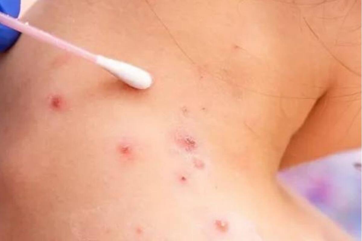 Viruela del mono: claves para entender la nueva crisis sanitaria