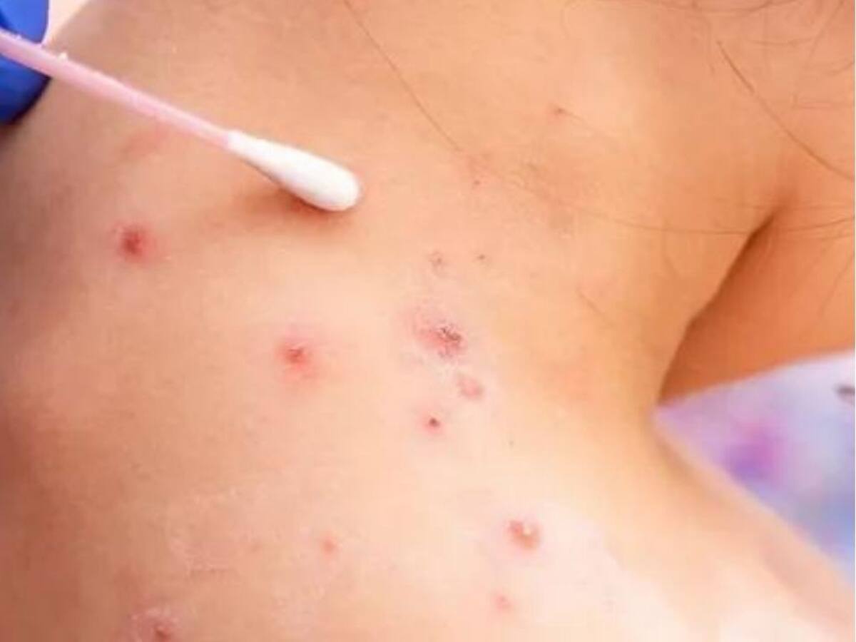 Enfermedad infecciosa que puede provocar una erupción dolorosa, inflamación de los ganglios linfáticos y fiebre. //Foto: Cortesía.