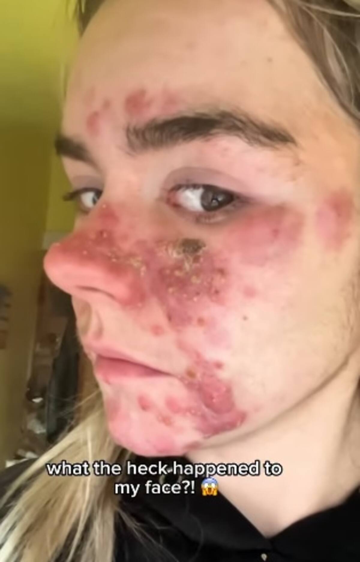 Exreina de belleza se sincera sobre su acné. //Foto tomada de IG@zenful_zoe/ @
skinselflovestory