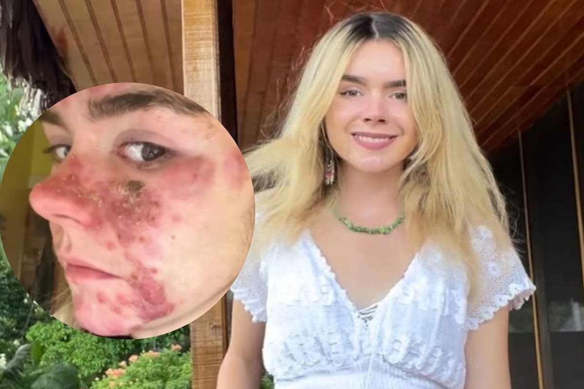 Exreina de belleza habla de su batalla contra el acné: “Tenía granos del tamaño de una uva”